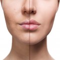 FILLER LABIALE TURGORE 