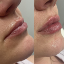 filler ac. ialuronico labiale